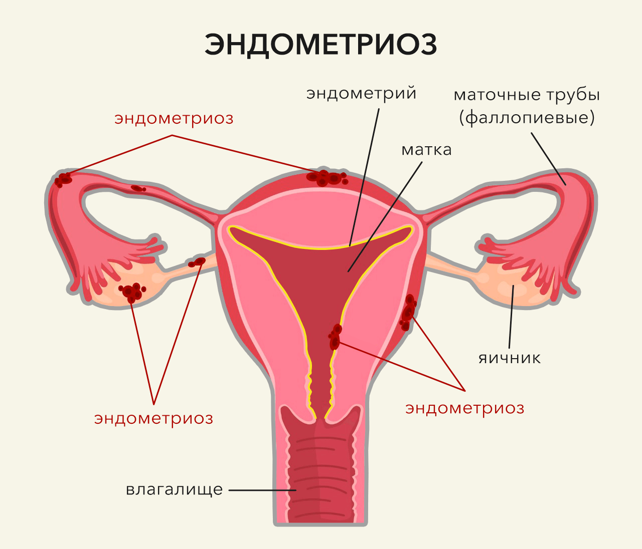 Эндометриоз матки – симптомы и лечение